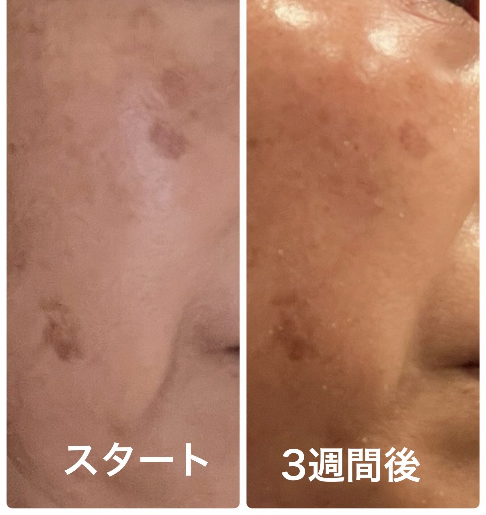 肌のハリとツヤとシミシワたるみ解決に/八王子フェイシャル