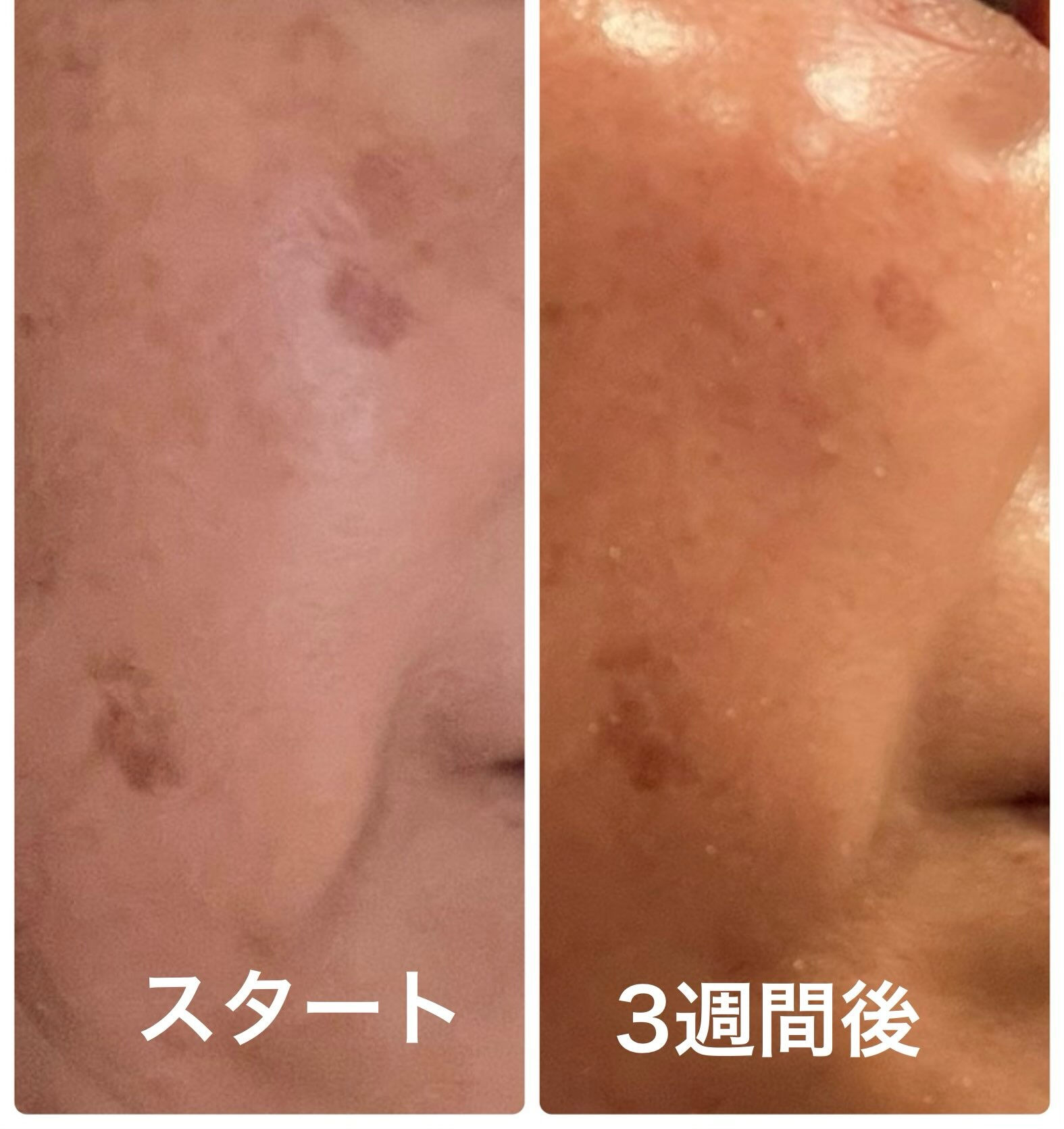 シミにも良かった✨